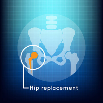 Hip Replacement Logo Vector Icon Design