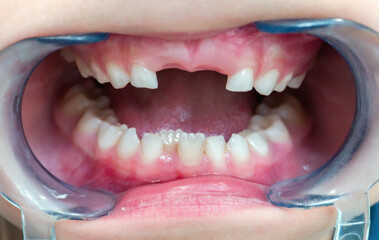 Little child's broken teeth