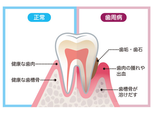 健康な歯と歯周病の歯　比較