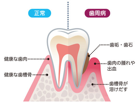健康な歯と歯周病の歯　比較