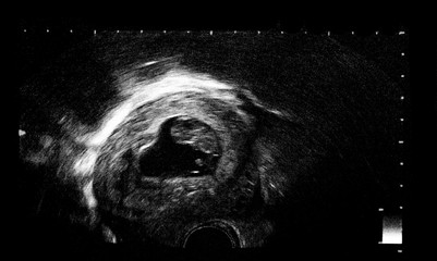 An ultrasound of a human fetus during the 11 week.