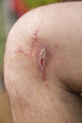 Irritant contact dermatitis at man leg, close up.