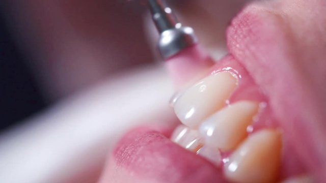 Extreme close-up shot of polishing female teeth with professional dental equipment. Visit to the dentist