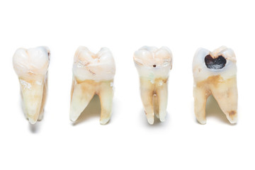 A tooth decay in 4 sides view isolated on white background.