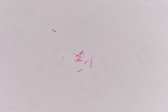 Mycrobacterium tuberculosis red cells.