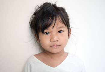 Varicella virus or chickenpox bubble rash on  Asian little girl with illness varicella.
