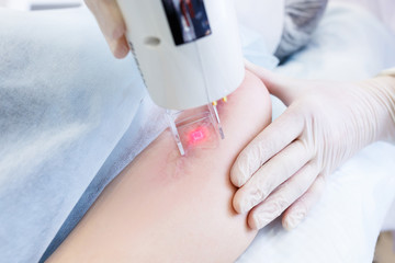 Woman getting a laser skin treatment or Laser resurfacing of scars - obrazy, fototapety, plakaty