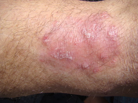 psoriasis