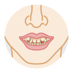Naklejka premium Bad dentition and dirty teeth