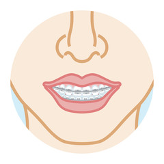 Obraz premium Orthodontics dentition, front view