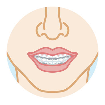 Orthodontics dentition, front view