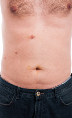 Naklejka premium Male abdomen with stitches after gallbladder removal