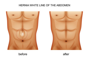 hernia white line of the abdomen
