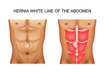 hernia white line of the abdomen 2 - obrazy, fototapety, plakaty