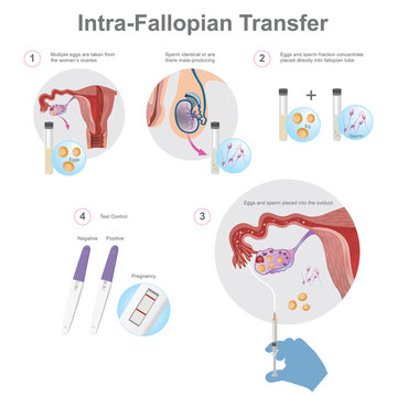 Intra-Fallopian Transfer