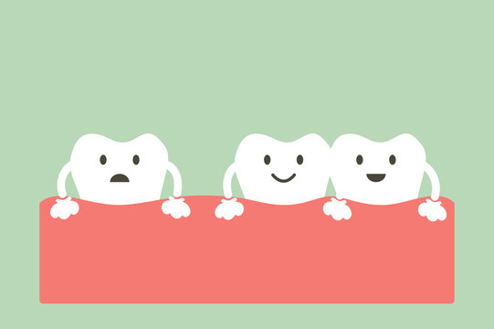 spacing teeth ( diastema )
