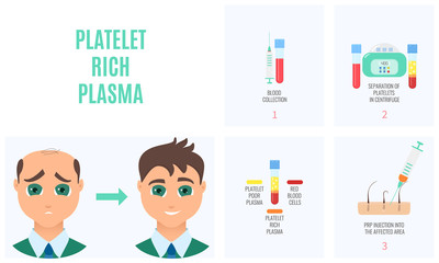 Platelet rich plasma injection procedure. PRP therapy process for men. Male hair loss treatment infographics. Meso therapy. Hair regrowth stimulation method. Vector illustration.