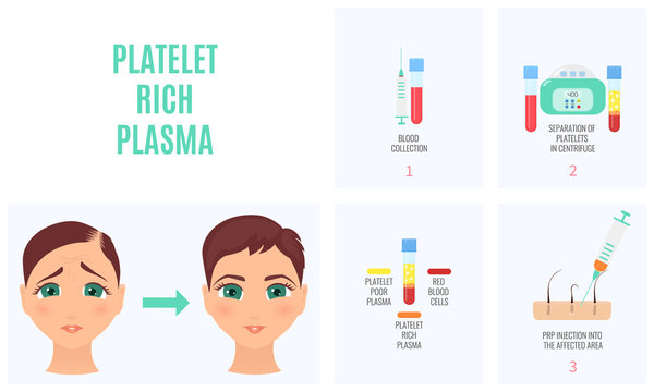 Female hair loss treatment with platelet rich plasma injection procedure. PRP therapy process for women. Vector illustration.