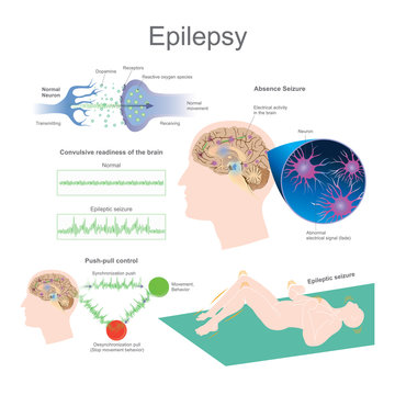 Epileptic seizures are the result of excessive and abnormal nerve cell activity in the cortex of the brain. Education infographic vector.