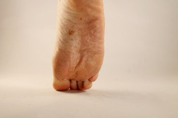 Fungus of foot close-up, isolated on white background. The concept dermatology, treatment fungal...