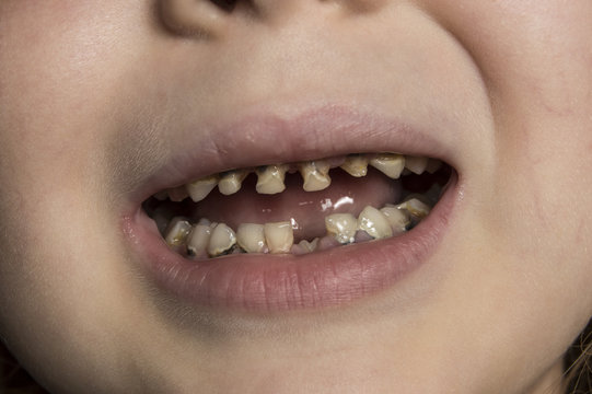 unhealthy baby teeth