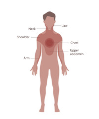 Fototapeta premium Heart Attack Pain Location