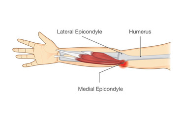 Obraz na płótnie Canvas Muscle injury and tear in tendon at elbow area from twisting and motions. Illustration about medical and science.