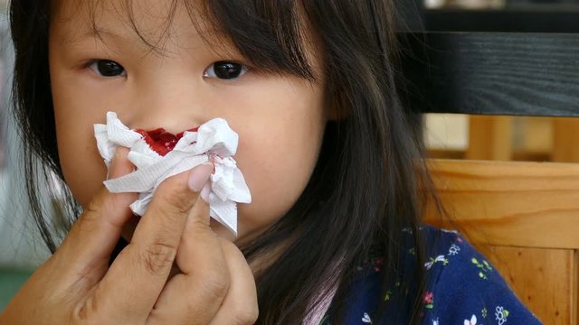 Mother wipe her daughter's bleeding nose by tissue paper
