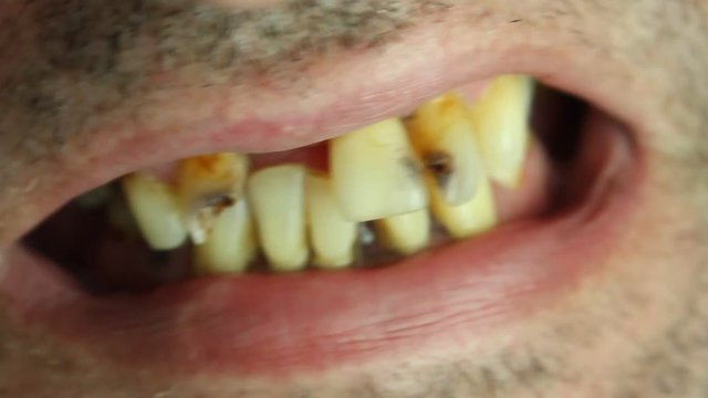 Bad teeth. Unhealthy teeth, caries and inflammation in mouth