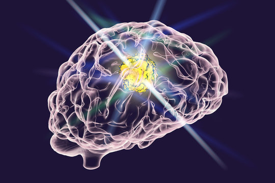 Destruction of brain tumor by laser, 3D illustration. Conceptual image for brain cancer treatment