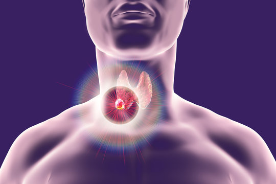 Destruction of thyroid tumor, 3D illustration. Conceptual image for thyroid cancer treatment