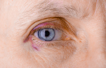 Woman's eye injured due to rupture of capillary, causing hematoma or bruising. It could also be...