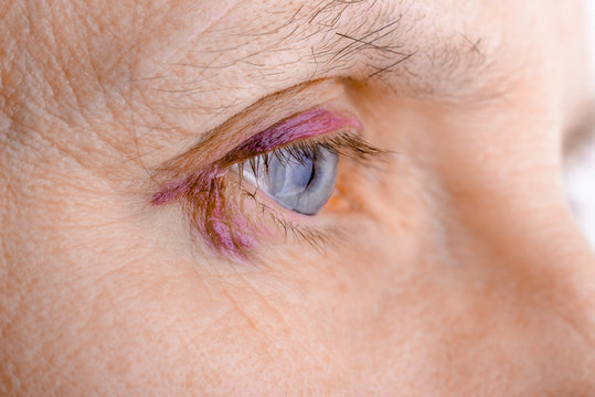 Woman's eye injured due to rupture of capillary, causing hematoma or bruising. It could also be conjunctivitis or other allergic eye inflammation