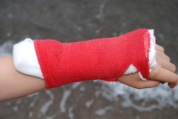 Children hand bone broken from accident with arm splint