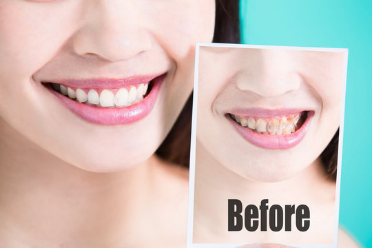tooth whiten concept