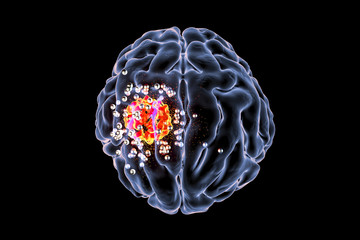 Destruction of brain tumor by nanoparticles, 3D illustration. Conceptual image for brain cancer treatment using nanotechnology - obrazy, fototapety, plakaty