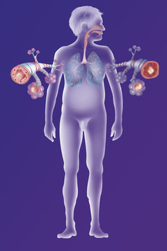 Depiction of a healthy bronchial tube (left) and a bronchial tube during an asthma attack (right)