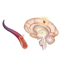 Depiction of an ischemic stroke, or cerebrovascular accident (CVA)