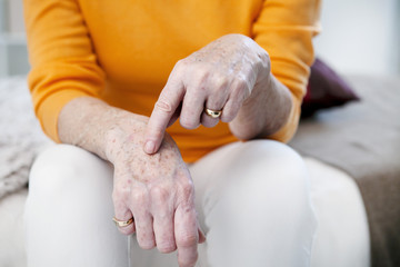 Age spots on senior woman hands