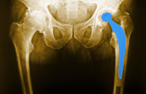 Hip Prosthesis,  X-ray