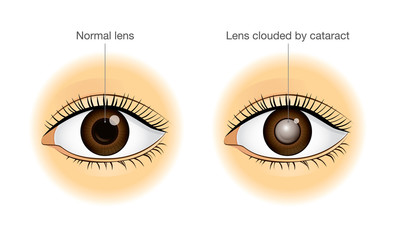 The difference between normal eye and lens clouded by cataract. Illustration about health and eyesight. - obrazy, fototapety, plakaty