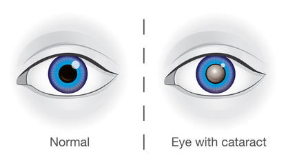 Normal eye and lens clouded by cataract. Illustration about health and eyesight.