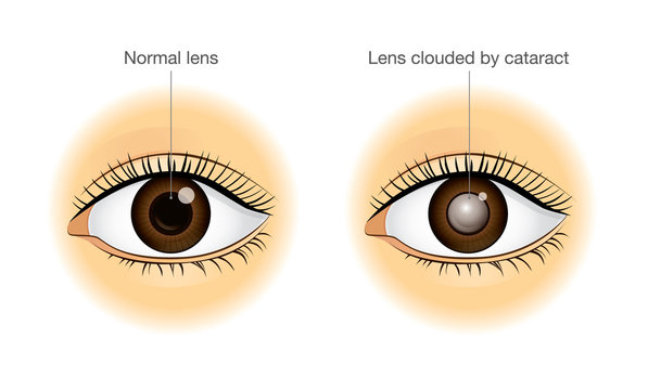 The difference between normal eye and lens clouded by cataract. Illustration about health and eyesight.