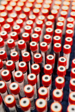 A row of human blood and chemistry samples awaiting testing in the lab