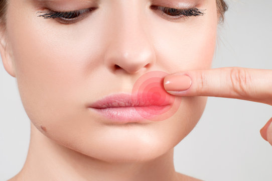 Close up of female lips affected by herpes virus