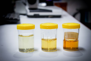 Urine sample