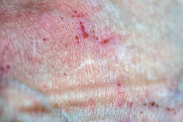 Fototapeta premium bad disease skin texture close up