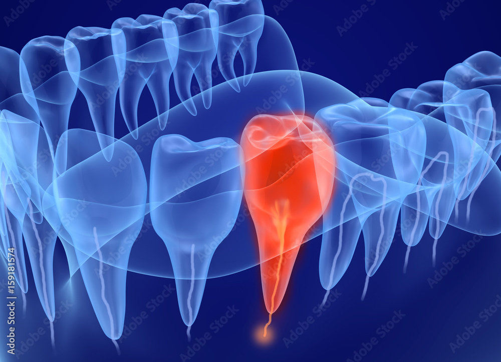 Wall mural problem teeth xray view. medically accurate tooth 3d illustration