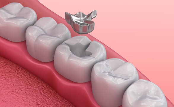 Metall dental fillings, Medically accurate 3D illustration