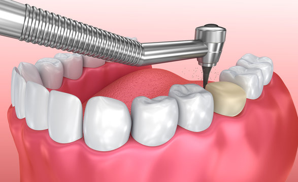 Dental crown installation process, Medically accurate 3d illustration